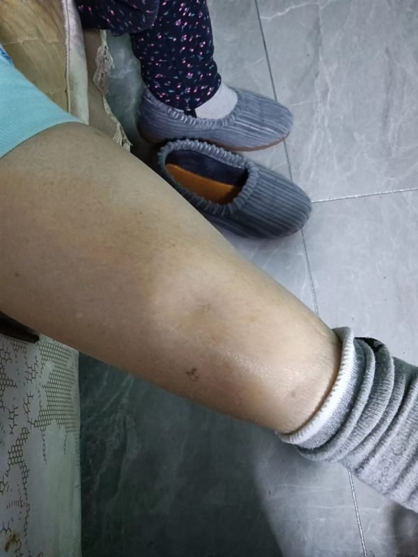 [Case study] One case of lower limb edema in a 72-year-old lady